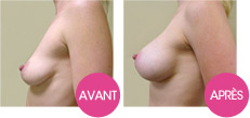 breastfast - augmentation mammaire
