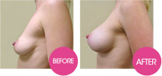 breastfast - augmentation mammaire